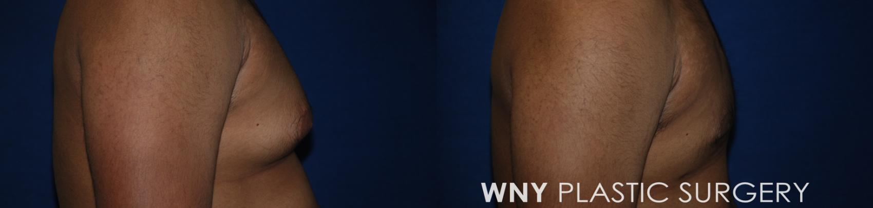 Before & After Male Breast Reduction Case 184 Right Side View in Williamsville, NY