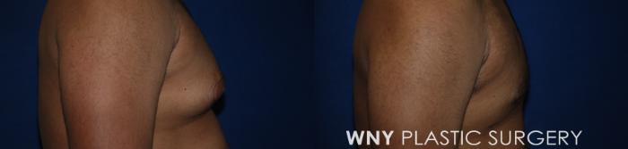 Before & After Liposuction Case 184 Right Side View in Williamsville, NY