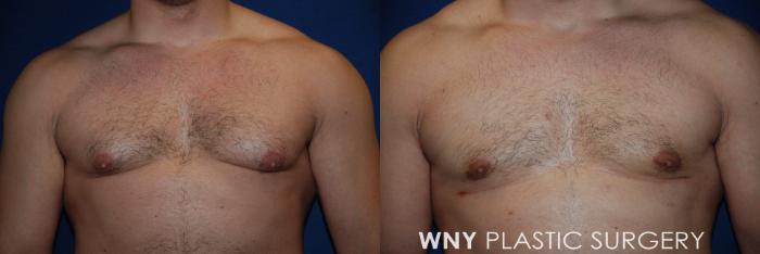 Before & After Male Breast Reduction Case 71 View #1 View in Williamsville, NY