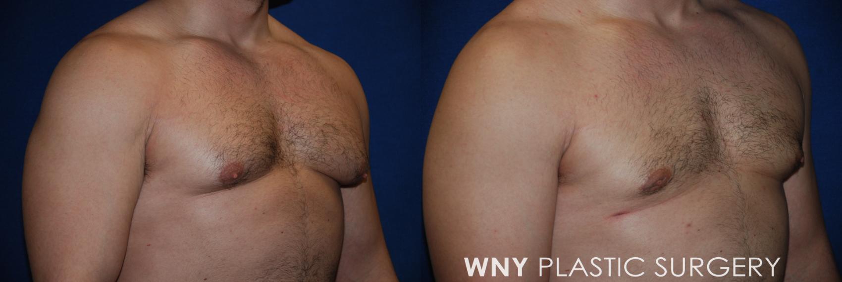 Before & After Male Breast Reduction Case 71 View #2 View in Williamsville, NY