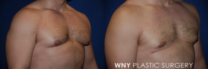 Before & After Male Breast Reduction Case 71 View #2 View in Buffalo, NY