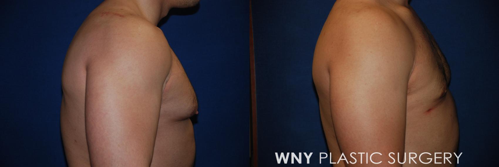 Before & After Male Breast Reduction Case 71 View #3 View in Williamsville, NY
