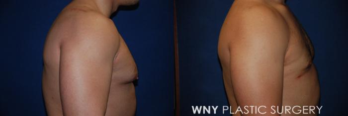 Before & After Male Breast Reduction Case 71 View #3 View in Buffalo, NY