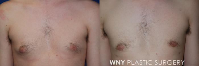 Before & After Male Breast Reduction Case 72 View #1 View in Williamsville, NY