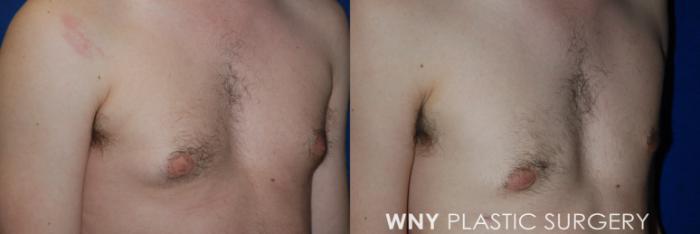 Before & After Male Breast Reduction Case 72 View #2 View in Buffalo, NY