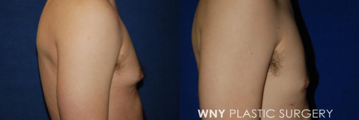 Before & After Male Breast Reduction Case 72 View #3 View in Buffalo, NY