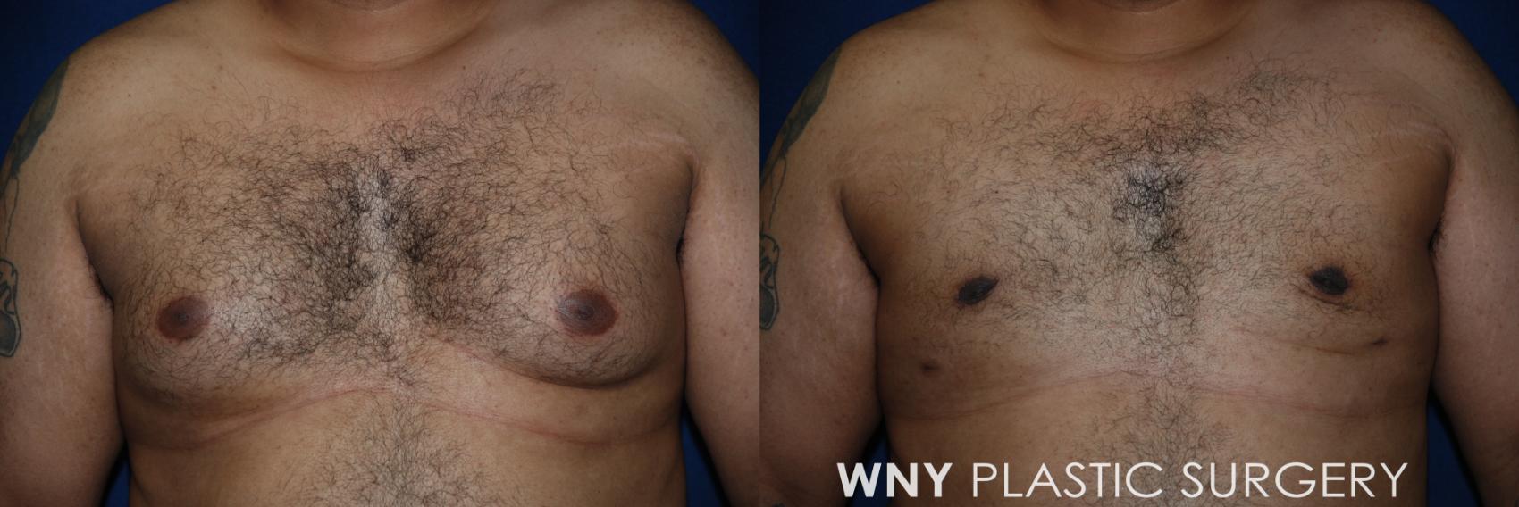 Before & After Male Breast Reduction Case 73 Front View in Williamsville, NY