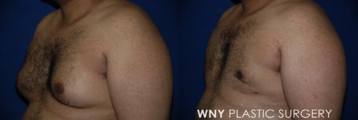 Before & After Male Breast Reduction Case 73 Left Oblique View in Williamsville, NY