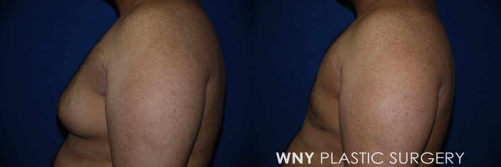 Before & After Male Breast Reduction Case 73 Left Side View in Williamsville, NY