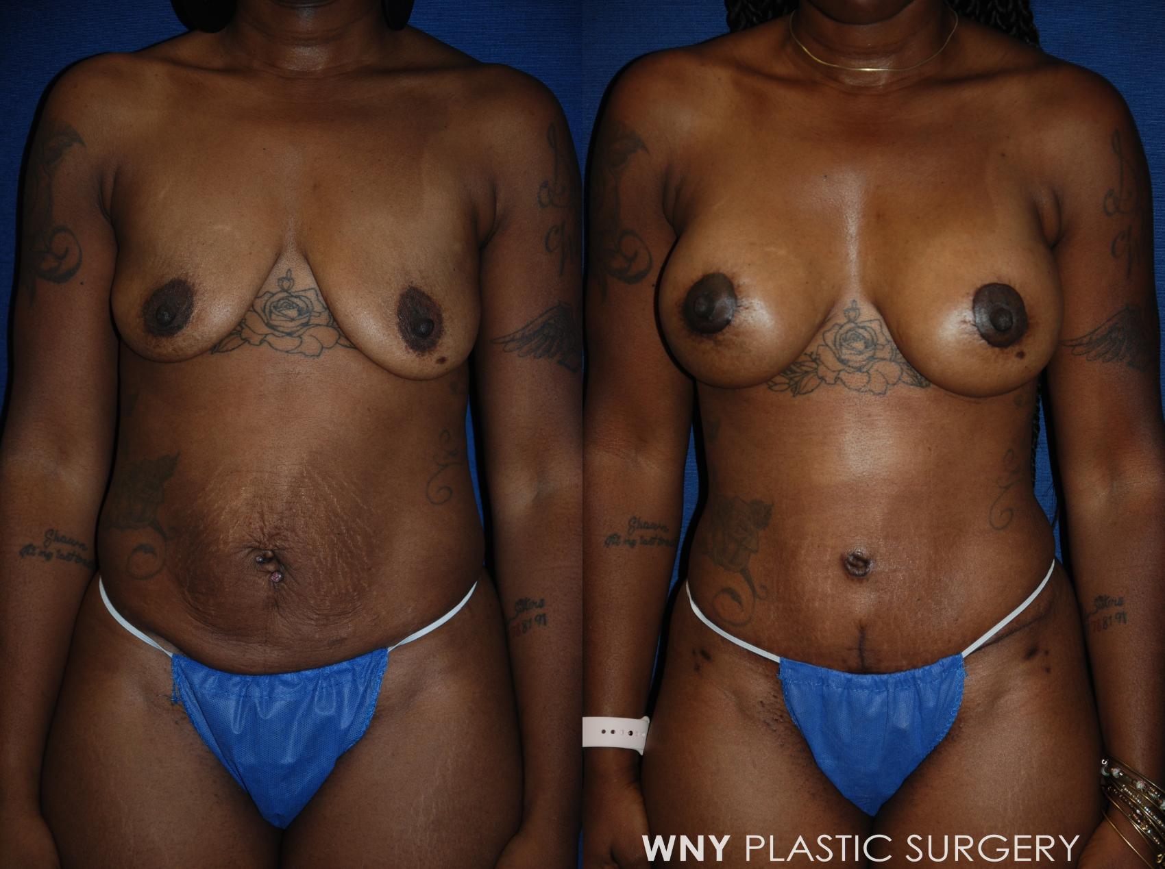 Before & After Breast Augmentation & Mini Lift Case 114 Front View in Buffalo, NY