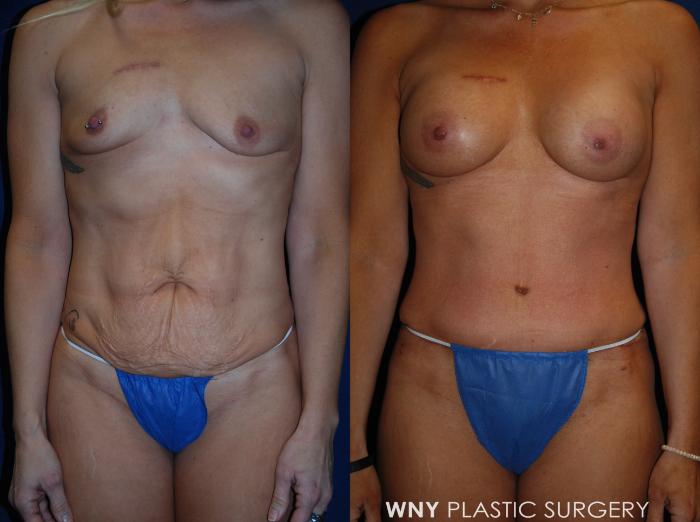 Before & After Tummy Tuck Case 170 Front View in Williamsville, NY