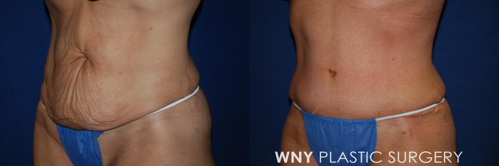 Before & After Mommy Makeover Case 170 Left Oblique View in Williamsville, NY