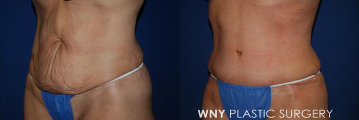 Before & After Tummy Tuck Case 170 Left Oblique View in Williamsville, NY