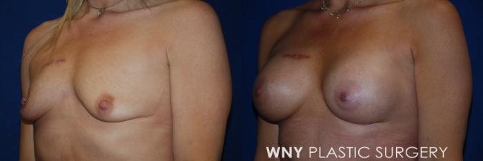 Before & After Tummy Tuck Case 170 Left Side View in Williamsville, NY