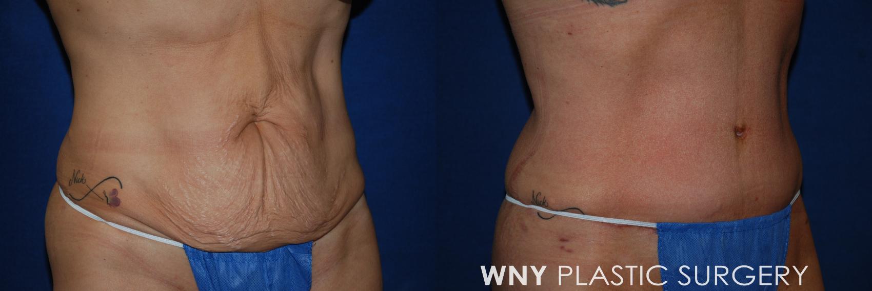 Before & After Mommy Makeover Case 170 Right Oblique View in Williamsville, NY