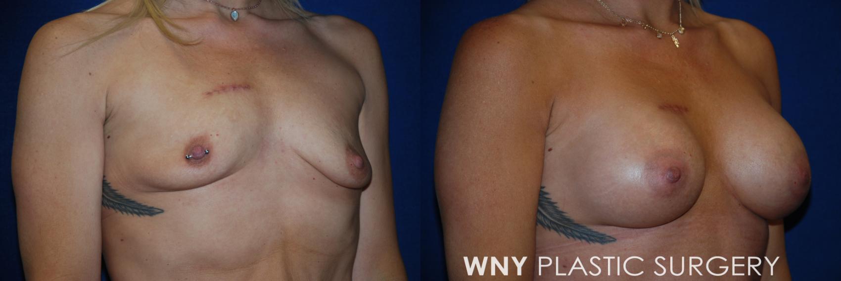 Before & After Mommy Makeover Case 170 Right Side View in Williamsville, NY