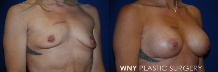 Before & After Tummy Tuck Case 170 Right Side View in Williamsville, NY