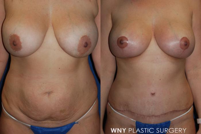 Before & After Breast Implant Replacement Case 174 Front View in Williamsville, NY