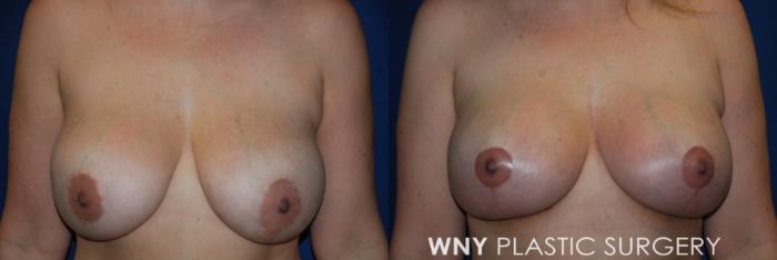 Before & After Breast Implant Replacement Case 174 Front Upper View in Buffalo, NY