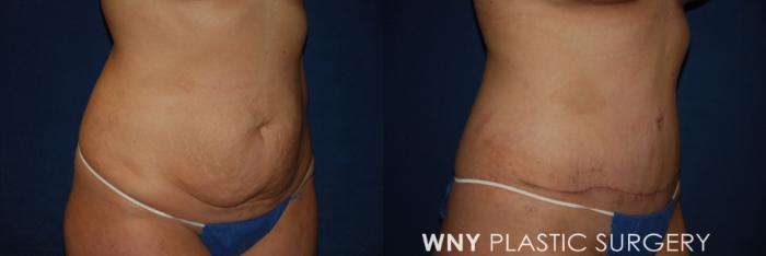Before & After Tummy Tuck Case 174 Right Oblique View in Buffalo, NY