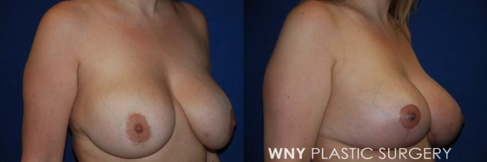Before & After Tummy Tuck Case 174 Right Side View in Buffalo, NY