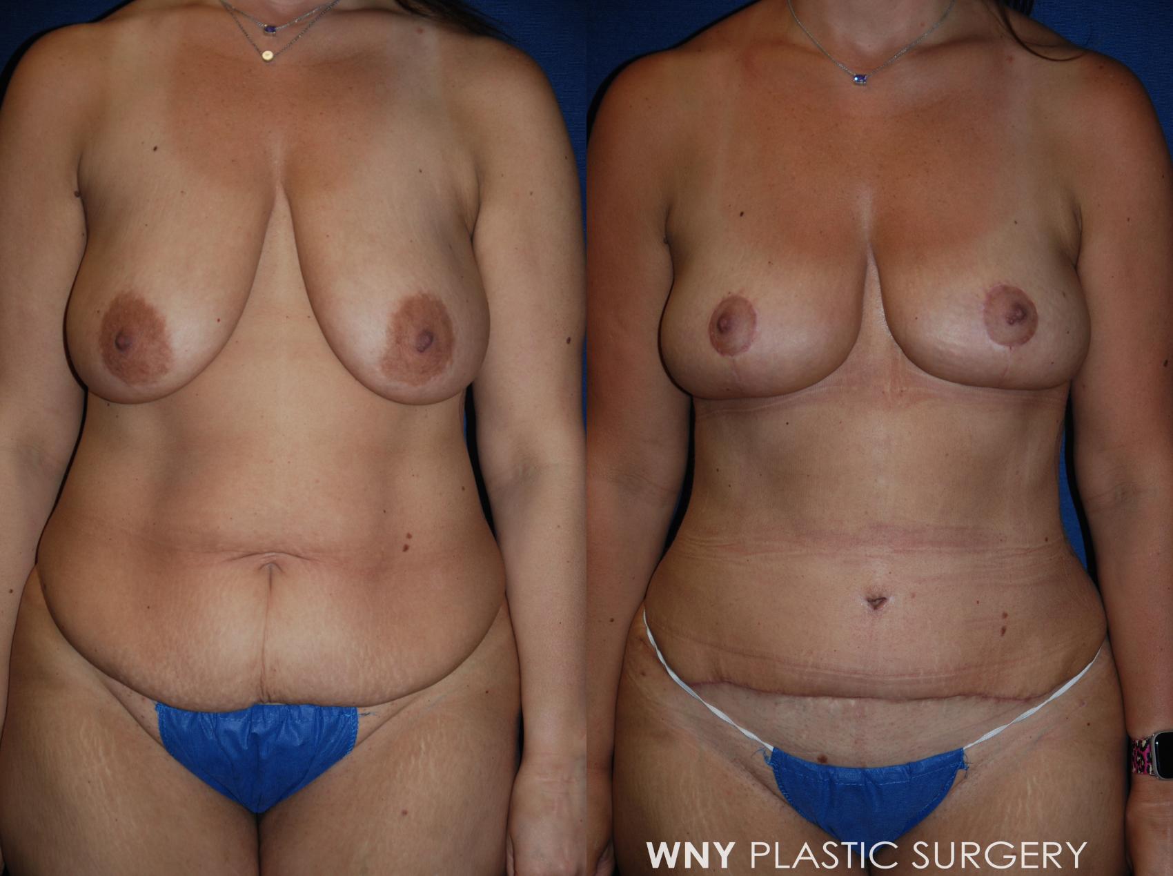 Before & After Tummy Tuck Case 185 Front View in Williamsville, NY