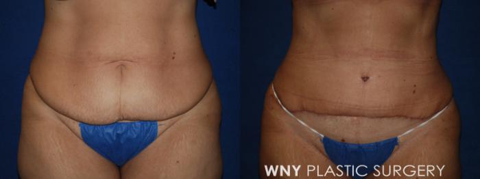 Before & After Tummy Tuck Case 185 Front Lower View in Buffalo, NY