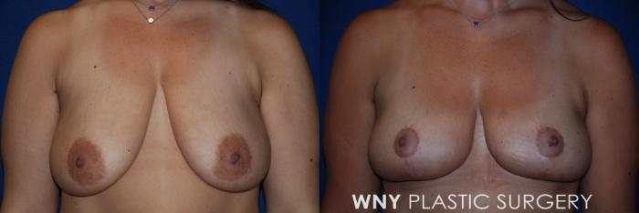 Before & After Breast Lift Case 185 Front Upper View in Buffalo, NY