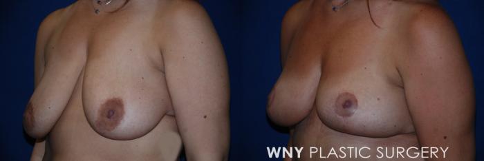 Before & After Mommy Makeover Case 185 Left Oblique View in Buffalo, NY