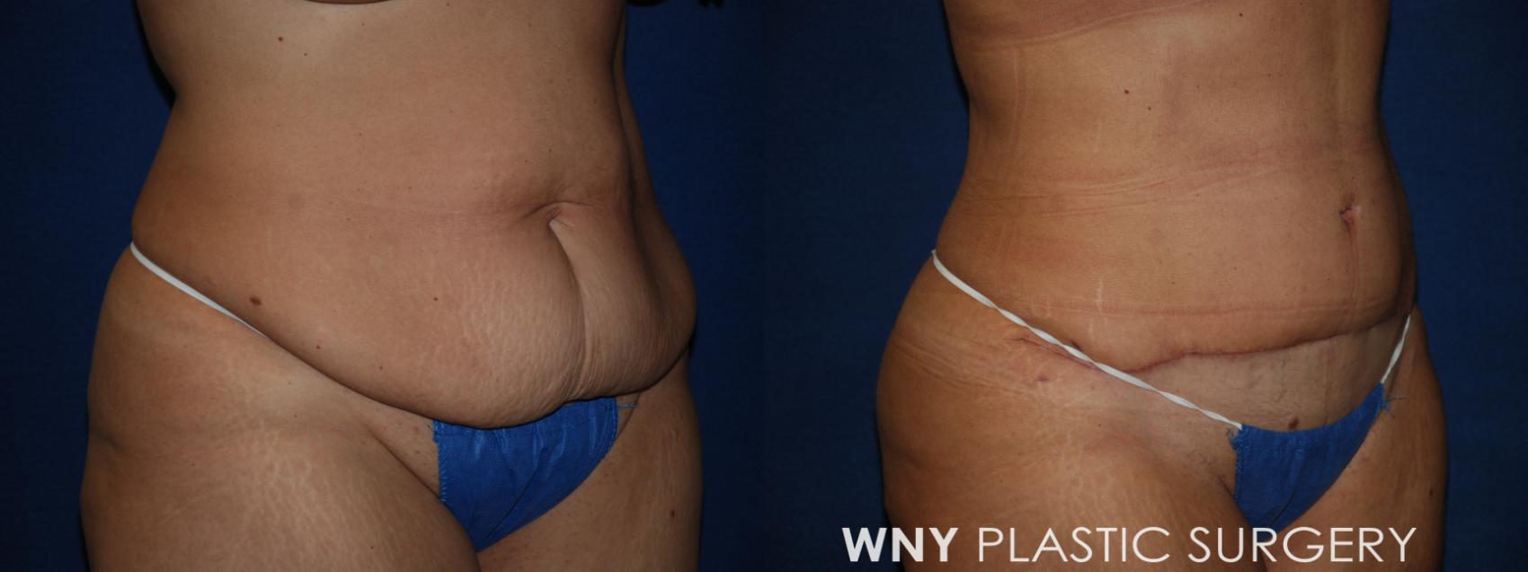 Before & After Mommy Makeover Case 185 Right Oblique View in Williamsville, NY