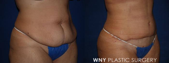 Before & After Tummy Tuck Case 185 Right Oblique View in Buffalo, NY