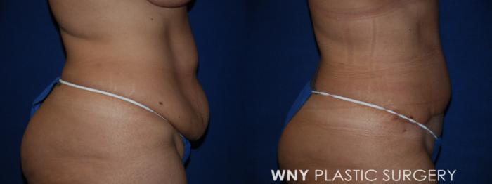 Before & After Tummy Tuck Case 185 Right Side View in Buffalo, NY