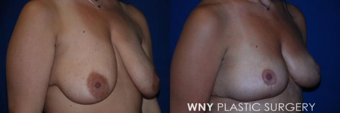 Before & After Breast Lift Case 185 Right Upper View in Buffalo, NY