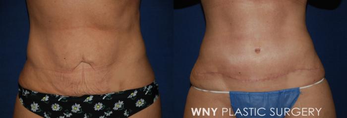 Before & After Tummy Tuck Case 186 Front Lower View in Buffalo, NY