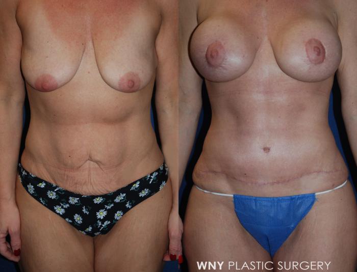 Before & After Breast Lift Case 186 Front View in Williamsville, NY