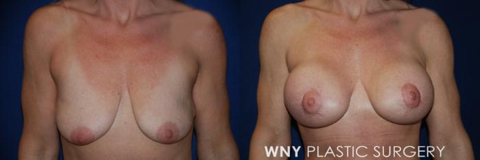 Before & After Breast Augmentation Case 186 Front Upper View in Buffalo, NY