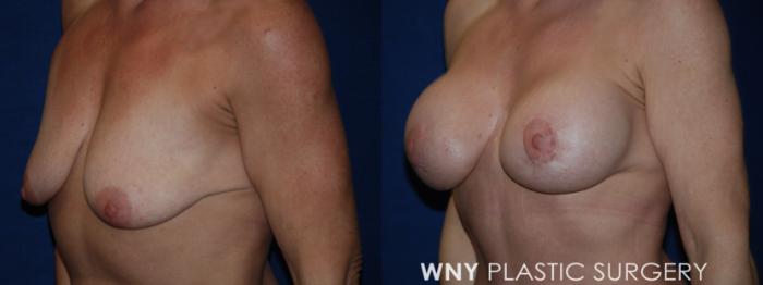 Before & After Tummy Tuck Case 186 Left Oblique View in Buffalo, NY