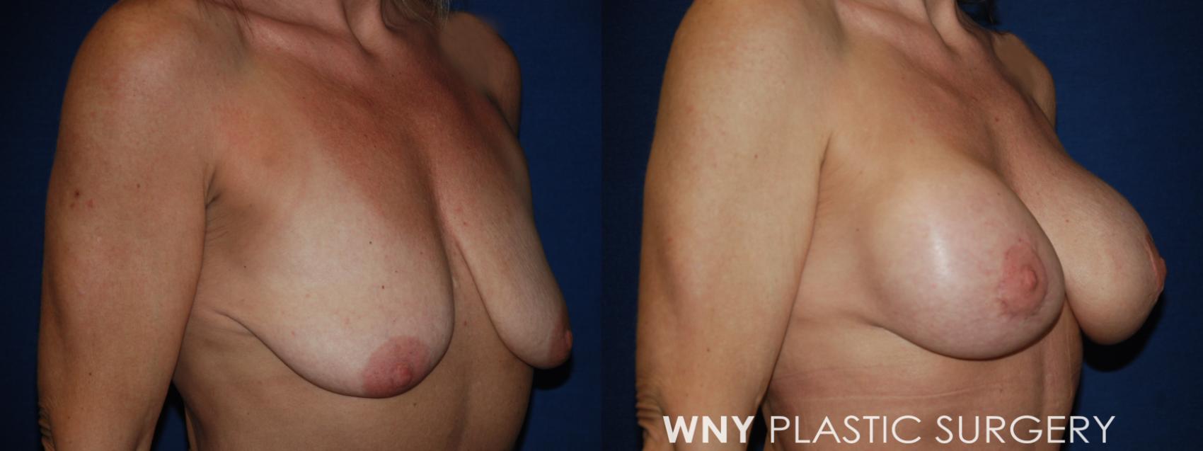 Before & After Mommy Makeover Case 186 Right Oblique View in Williamsville, NY