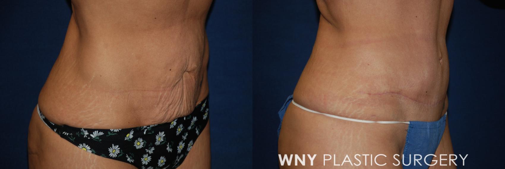 Before & After Mommy Makeover Case 186 Right Oblique Lower View in Williamsville, NY