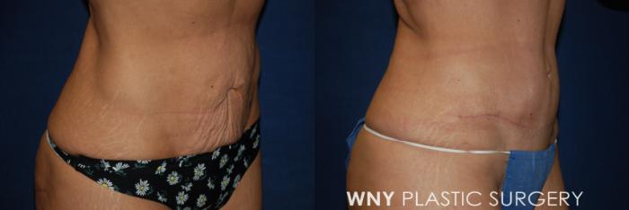 Before & After Breast Augmentation Case 186 Right Oblique Lower View in Buffalo, NY