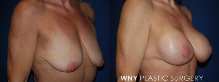 Before & After Breast Augmentation Case 186 Right Oblique View in Buffalo, NY