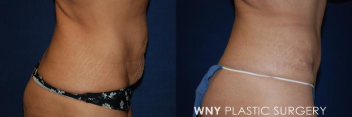 Before & After Tummy Tuck Case 186 Right Side Lower View in Buffalo, NY
