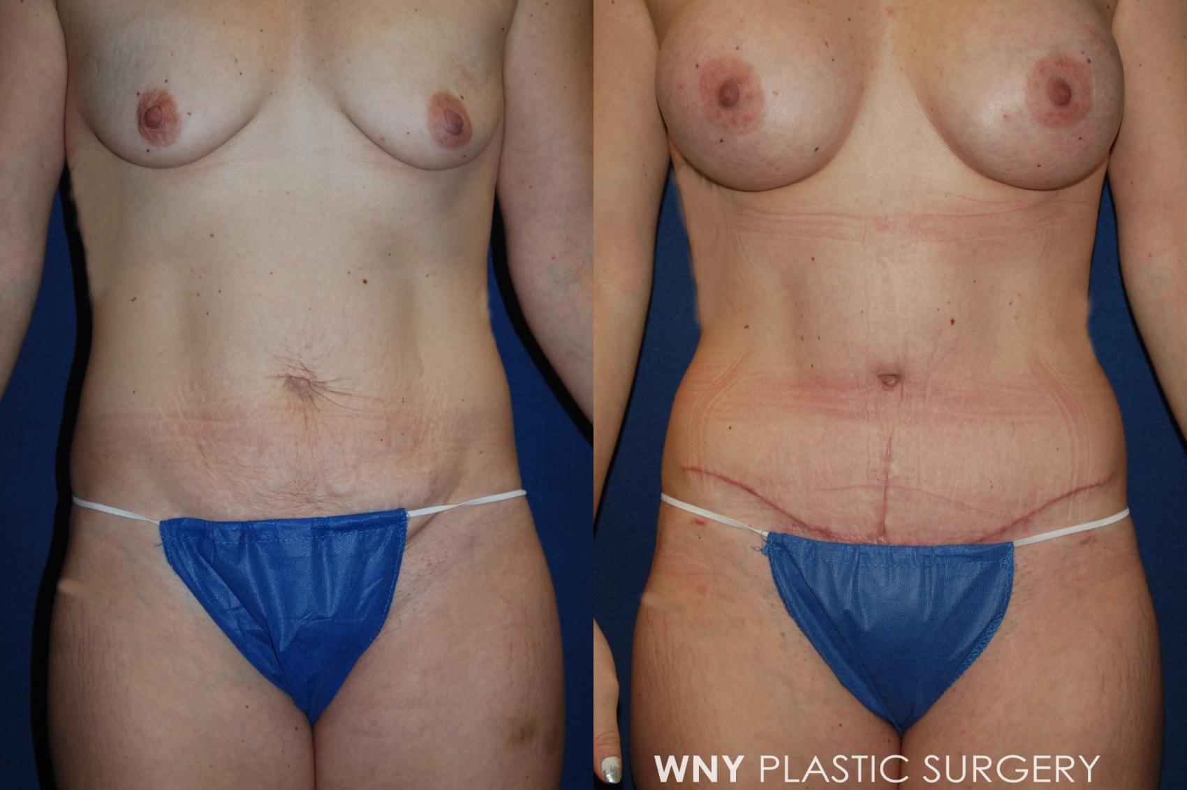 Before & After Breast Augmentation Case 191 Front View in Williamsville, NY