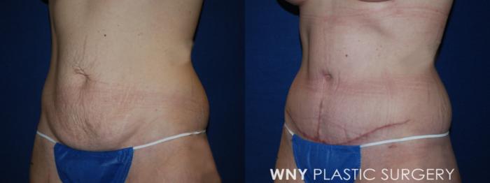 Before & After Breast Augmentation Case 191 Left Oblique Lower View in Buffalo, NY