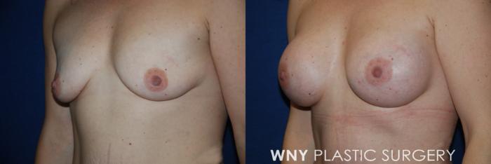 Before & After Mommy Makeover Case 191 Left Oblique View in Buffalo, NY