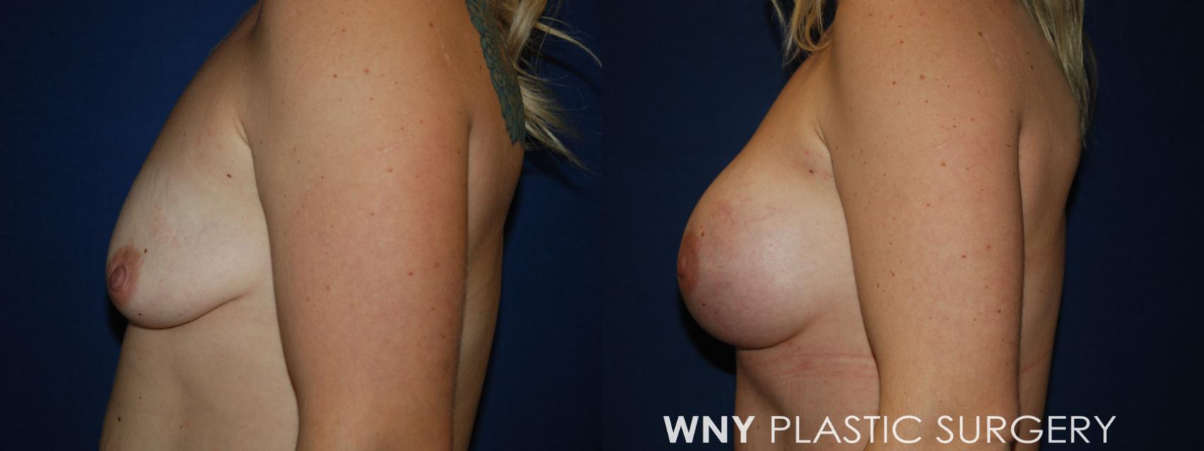 Before & After Mommy Makeover Case 191 Left Side View in Williamsville, NY