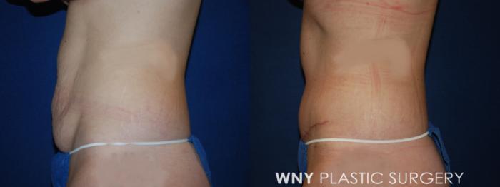 Before & After Tummy Tuck Case 191 Left Side Lower View in Williamsville, NY