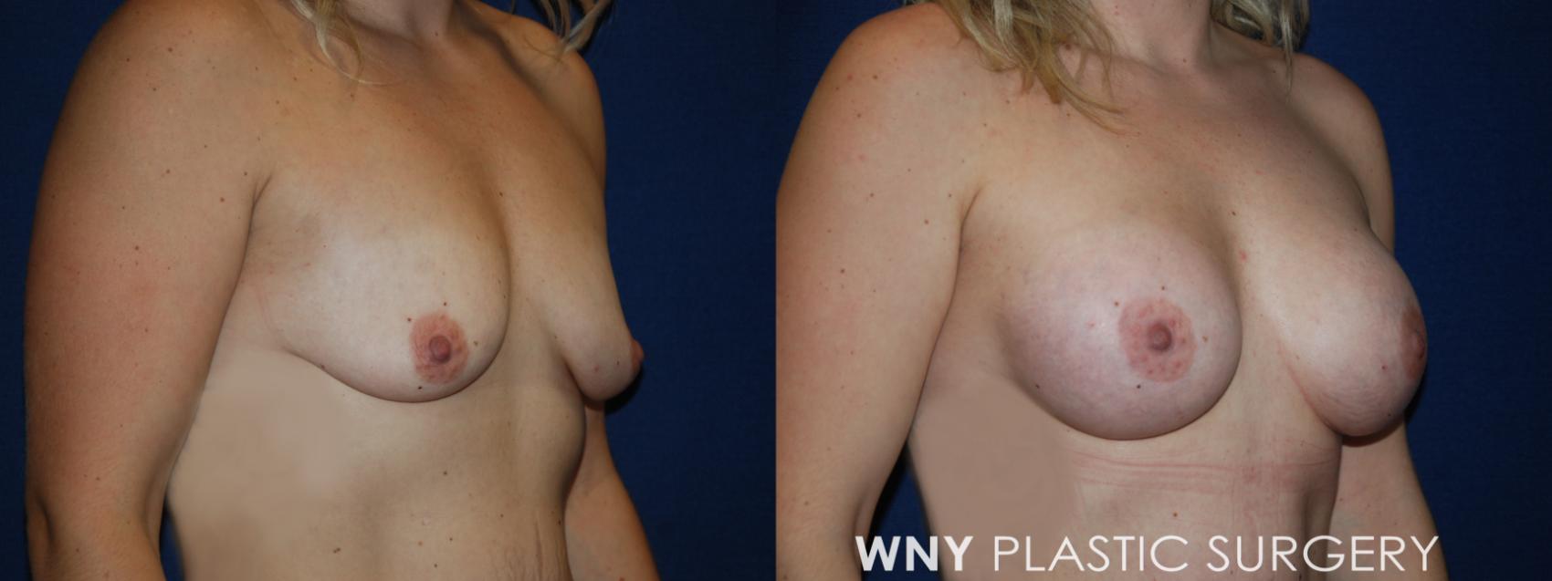 Before & After Mommy Makeover Case 191 Right Oblique View in Williamsville, NY