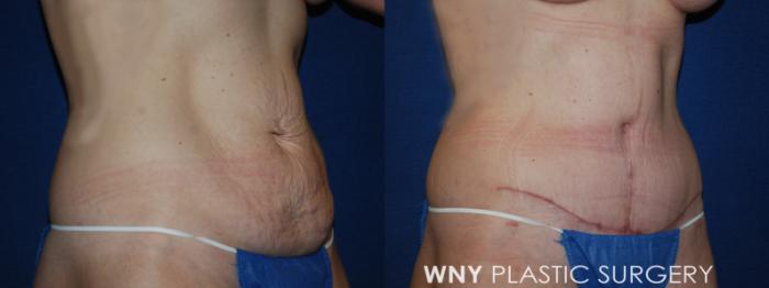 Before & After Tummy Tuck Case 191 Right Oblique Lower View in Williamsville, NY