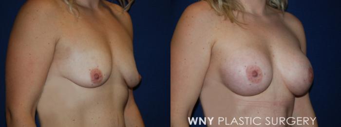Before & After Breast Augmentation Case 191 Right Oblique View in Buffalo, NY